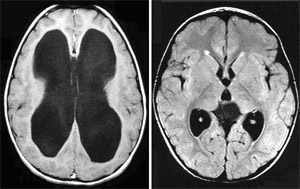 Hydrocephalus (left) and normal brain (right).